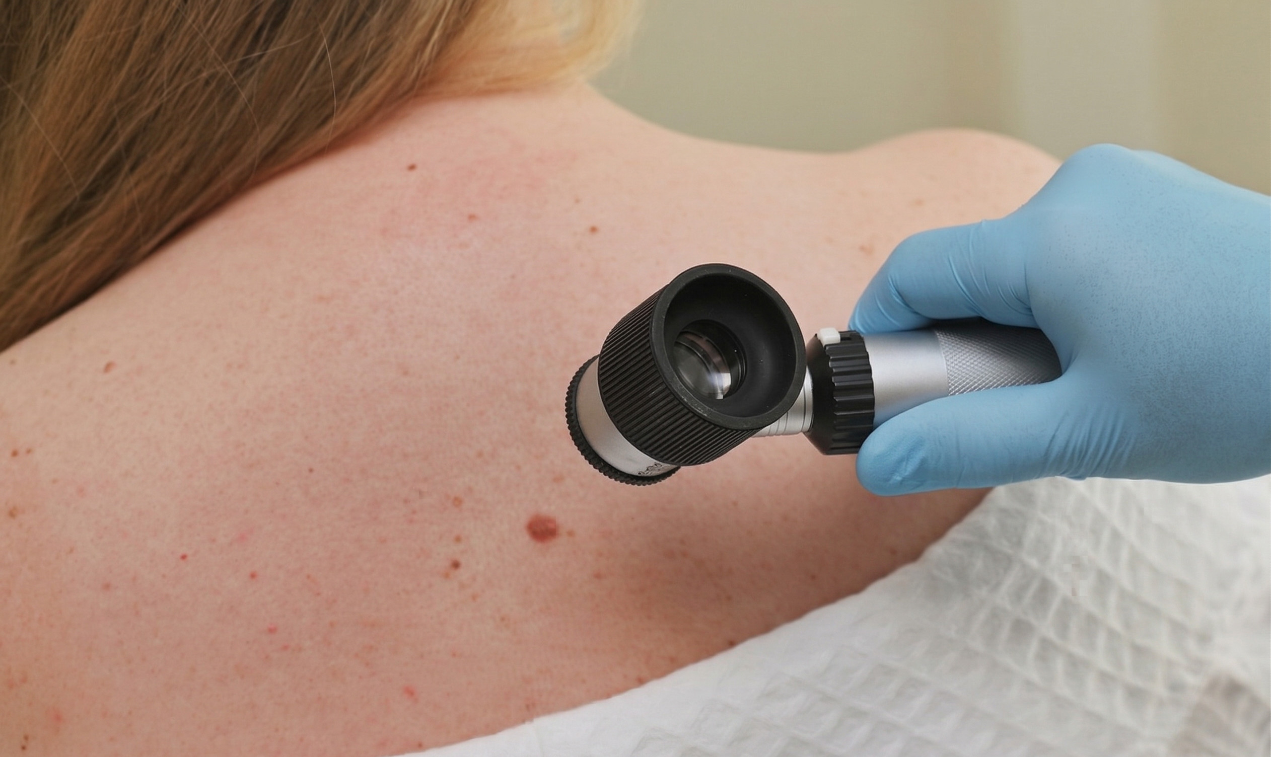 Evaluare dermatoscopică a alunițelor